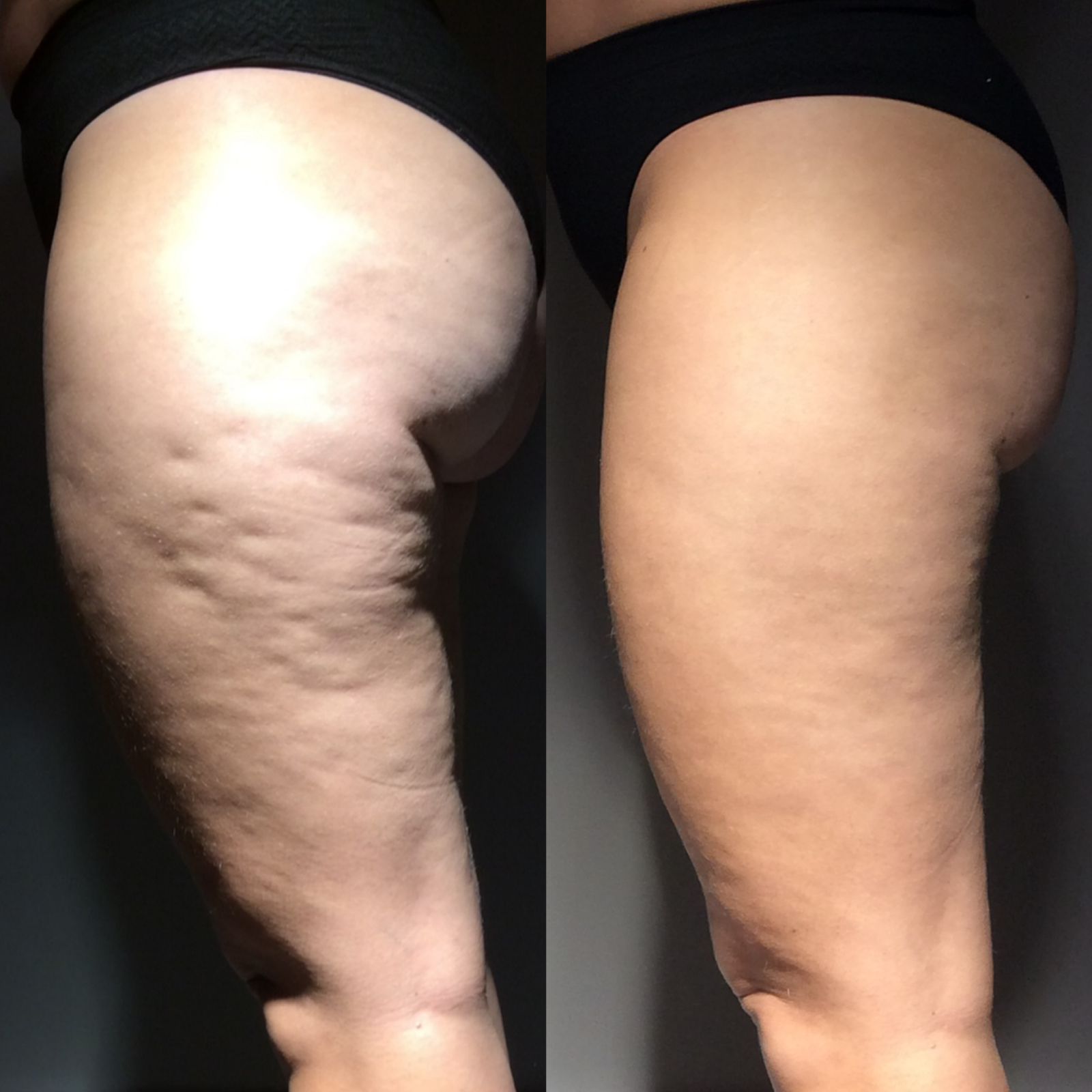 Skin Contour Technique 1