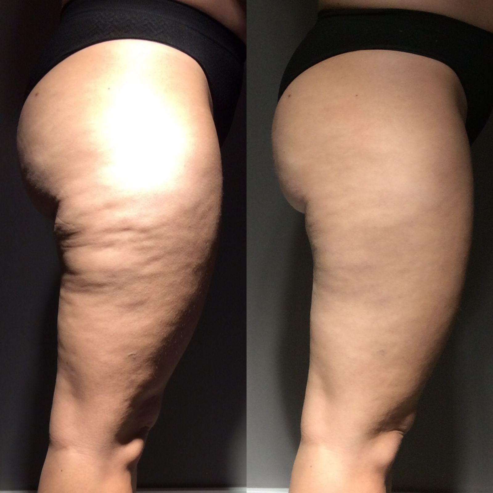 Skin Contour Technique 2
