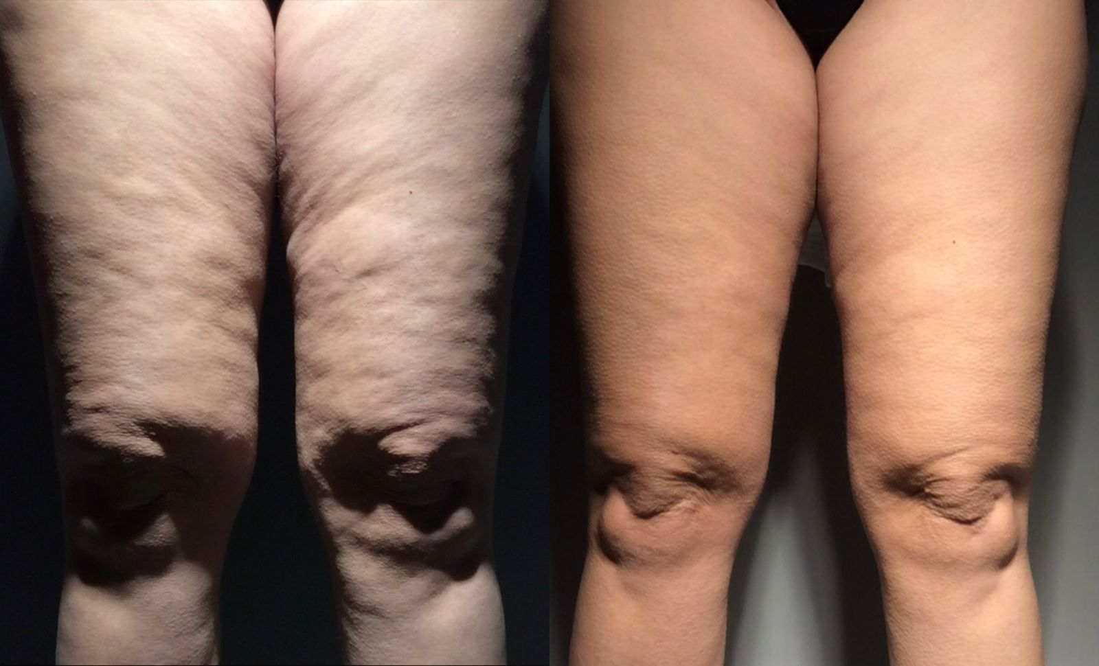 Skin Contour Technique 3