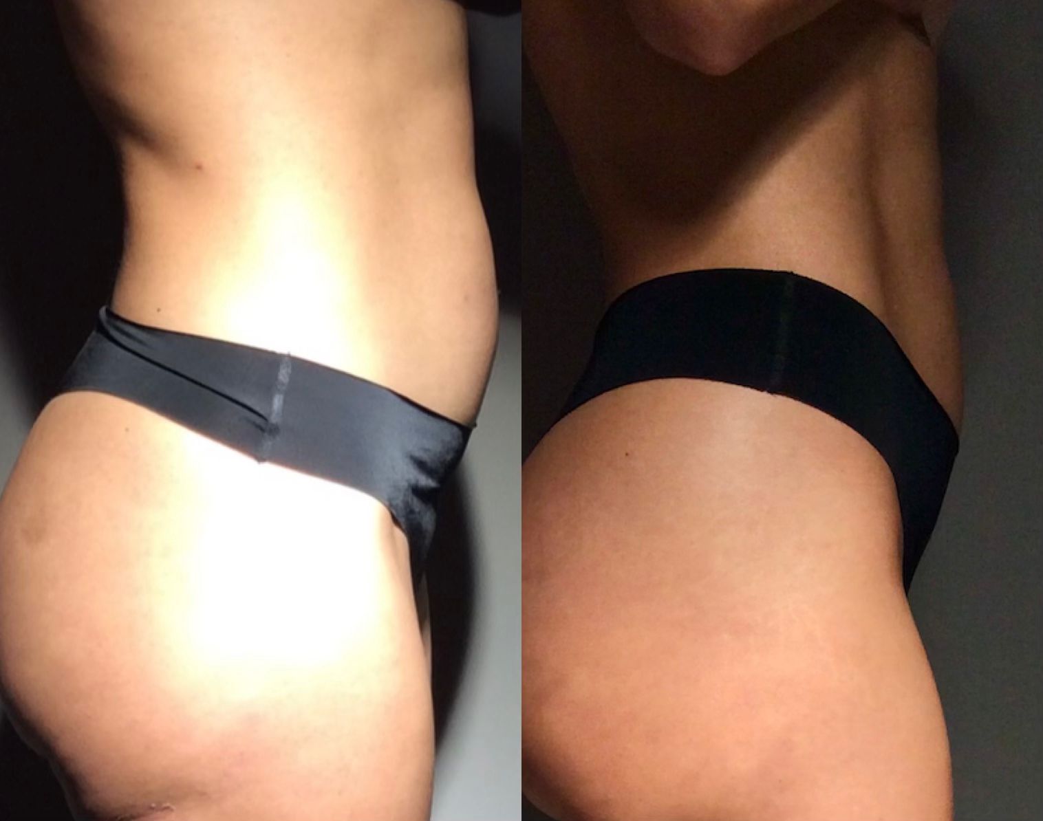 Skin Contour Technique 4