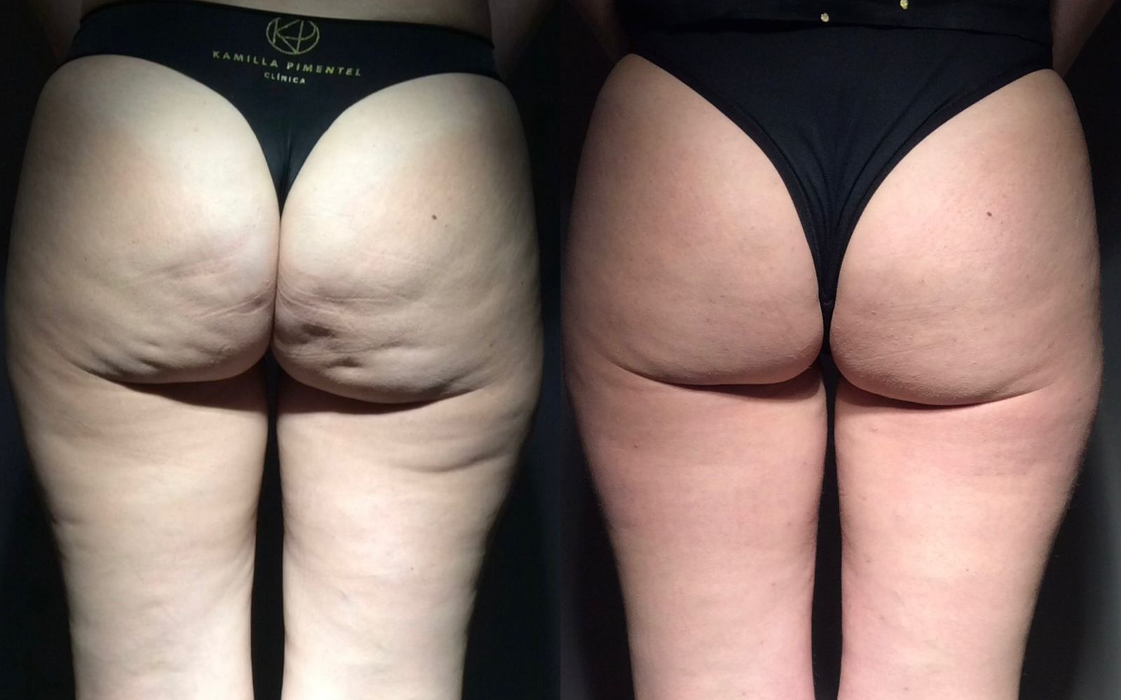 Skin Contour Technique 5