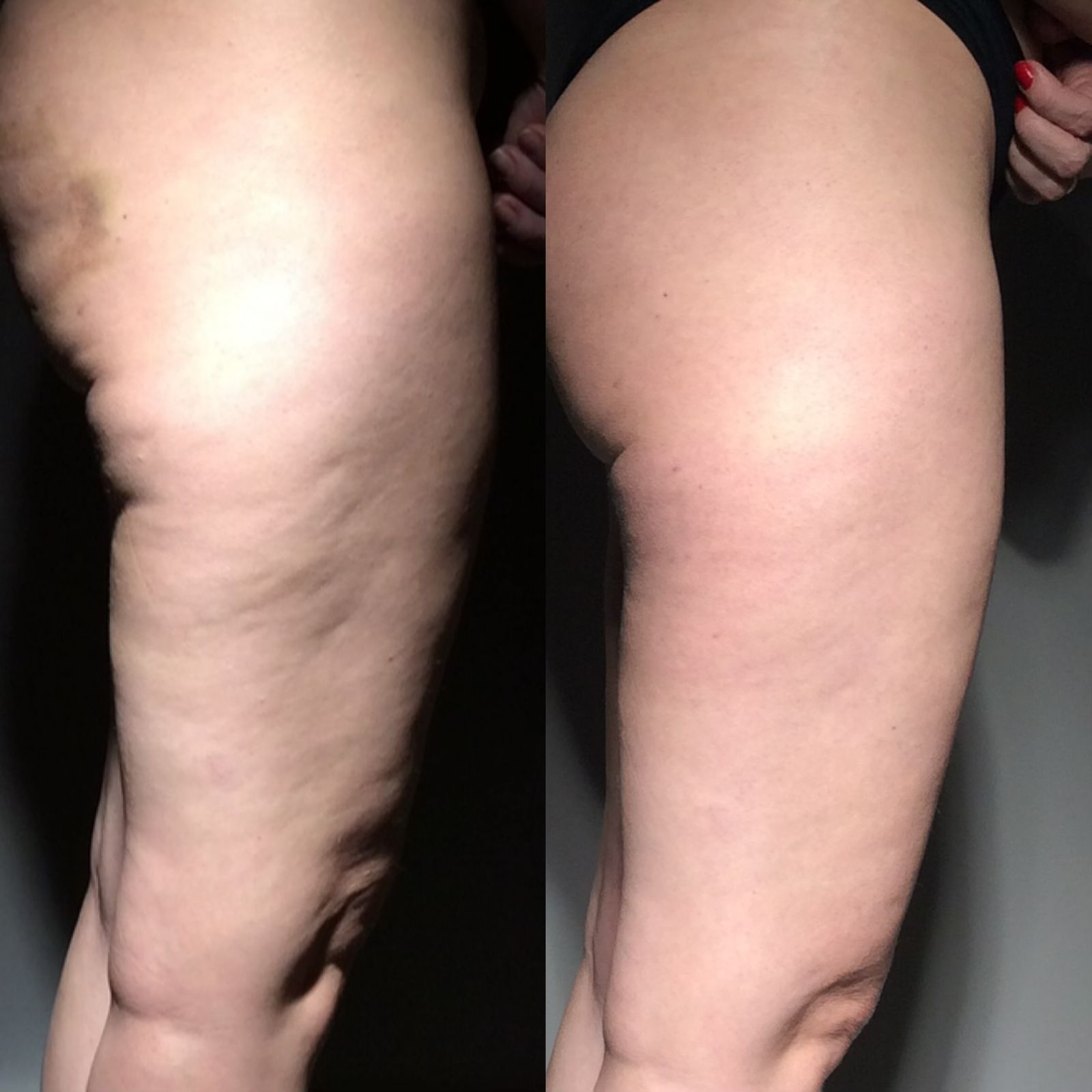 Skin Contour Technique 6