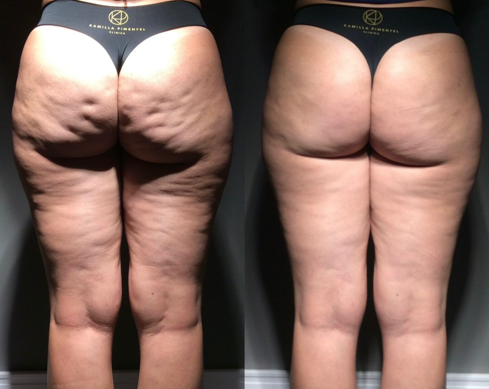 Skin Contour Technique 8